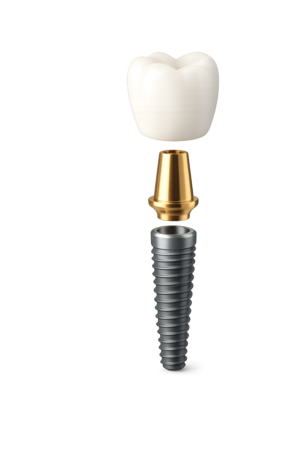Implante, pilar y corona — Dental One